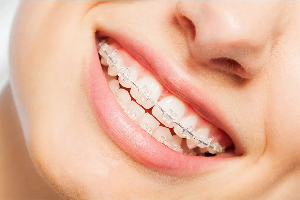 Brackets